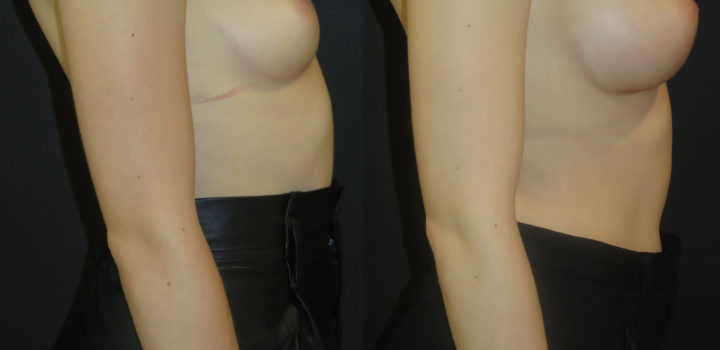 Augmentation mammaire par prothèse Dual Plan