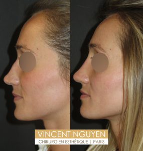 Rhinoplastie