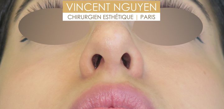 cicatrice de rhinoplastie ouverte