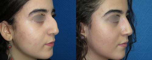 Rhinoplastie avant après