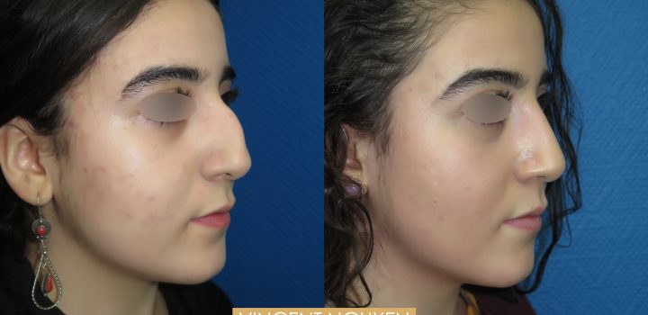 Rhinoplastie avant après