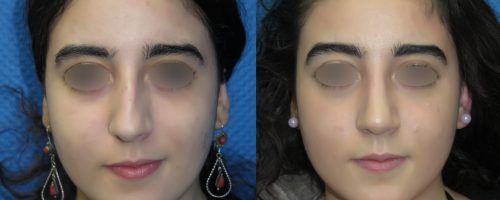 Rhinoplastie avant après