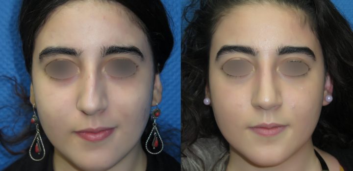 Rhinoplastie avant après