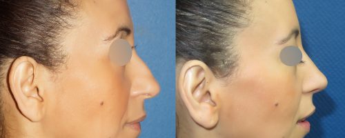 Rhinoplastie