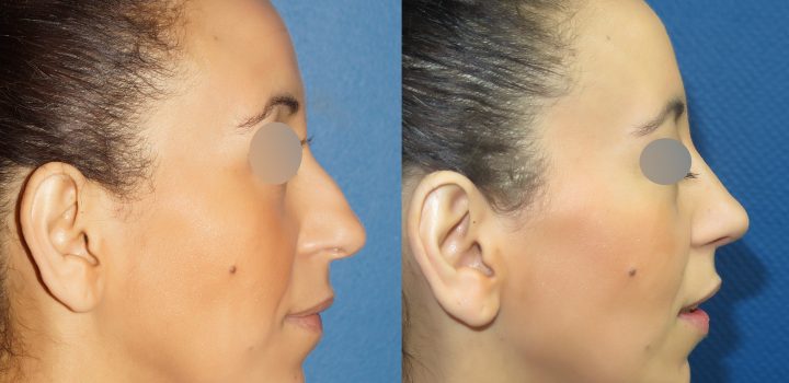 Rhinoplastie