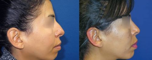 Rhinoplastie - résultat à 6 mois