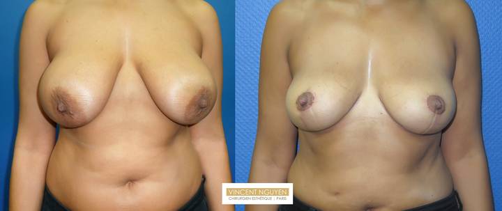 Réduction mammaire - résultation à 3 mois