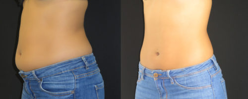 lipoaspiration abdomen et flancs