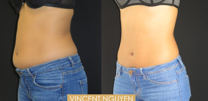 lipoaspiration abdomen et flancs