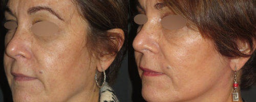 lifting cervico-facial