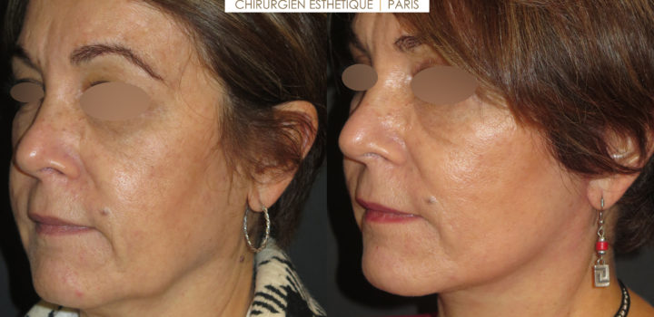 lifting cervico-facial