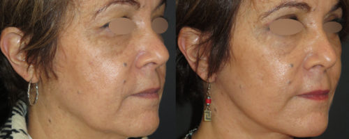 lifting cervico-facial