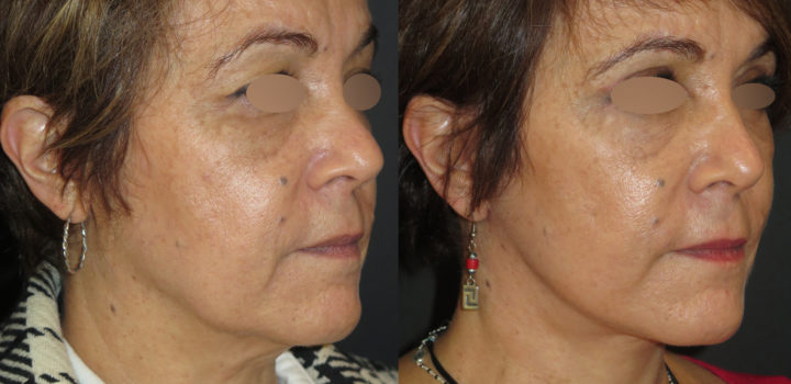 lifting cervico-facial