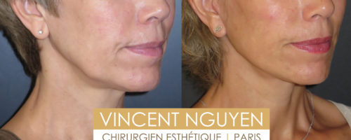 lifting cervico facial