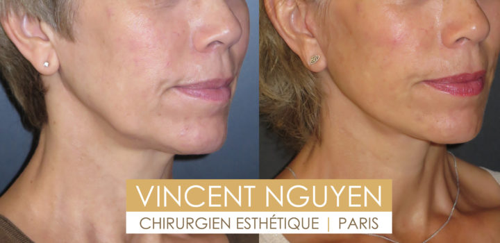 lifting cervico facial