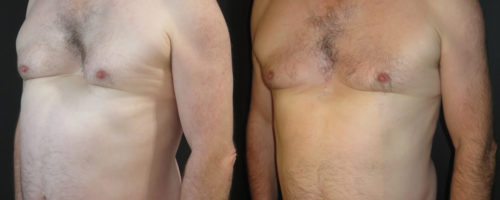 pectus excavatum