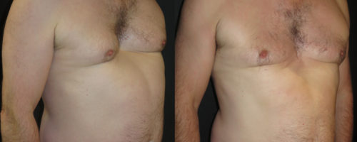 pectus excavatum