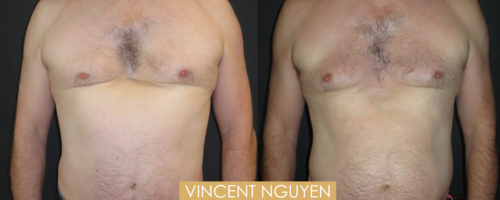 pectus excavatum