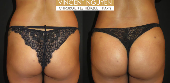 lipofilling des fesses