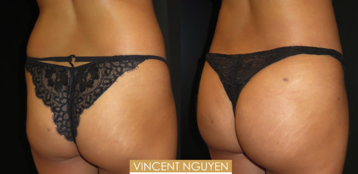 lipofilling des fesses