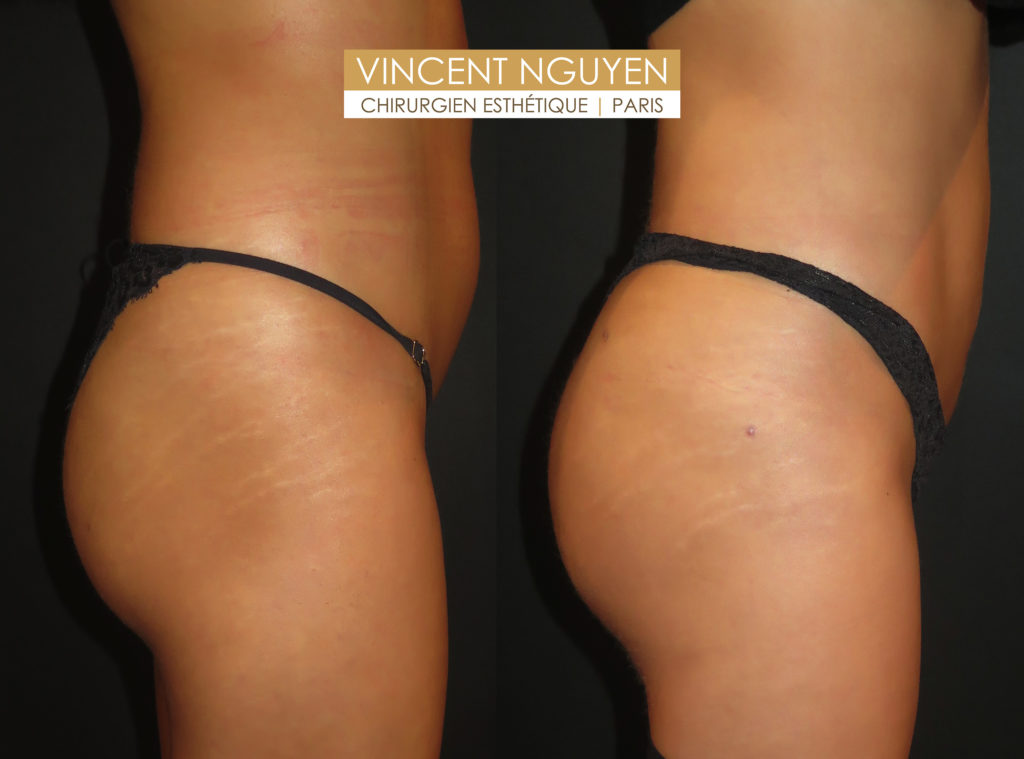 Lipofilling fessier ou des fesses : lifting brésilien Paris