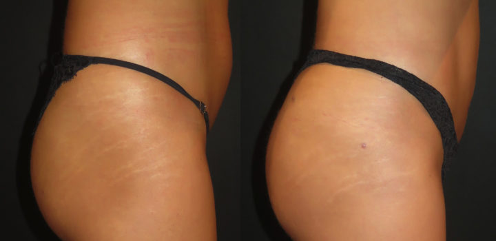 lipofilling des fesses