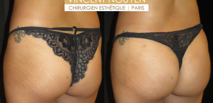 lipofilling des fesses