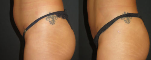 lipofilling des fesses