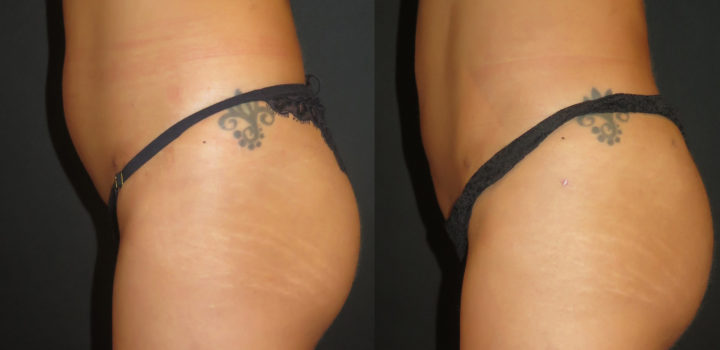 lipofilling des fesses