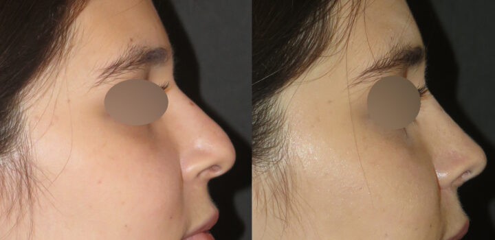 rhinoplastie