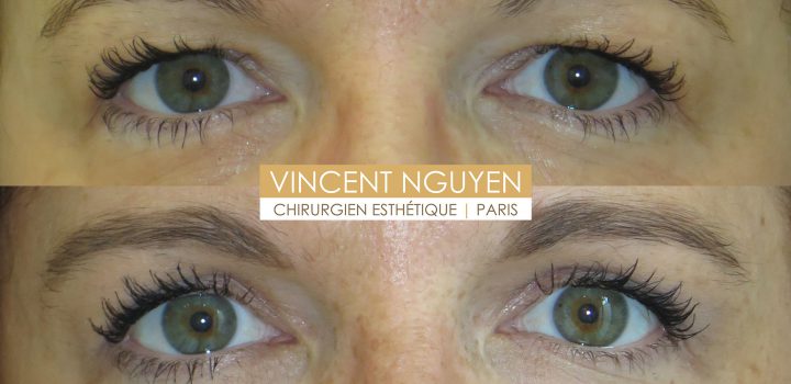 Blépharoplastie supérieure