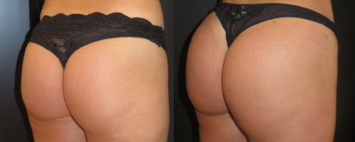 lipofilling de fesses