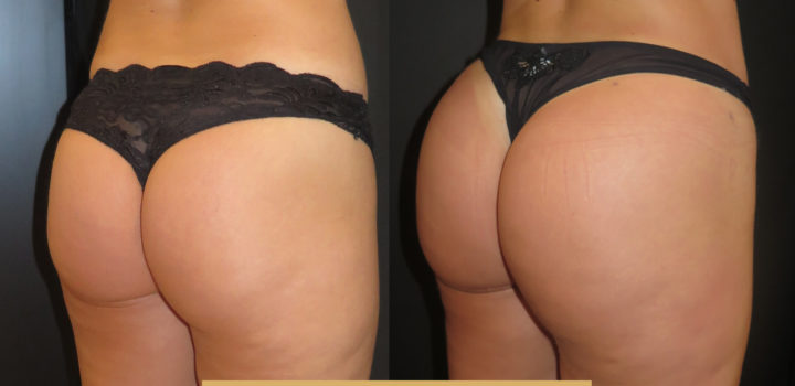 lipofilling de fesses