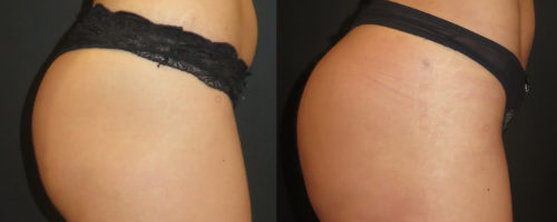 lipofilling de fesses