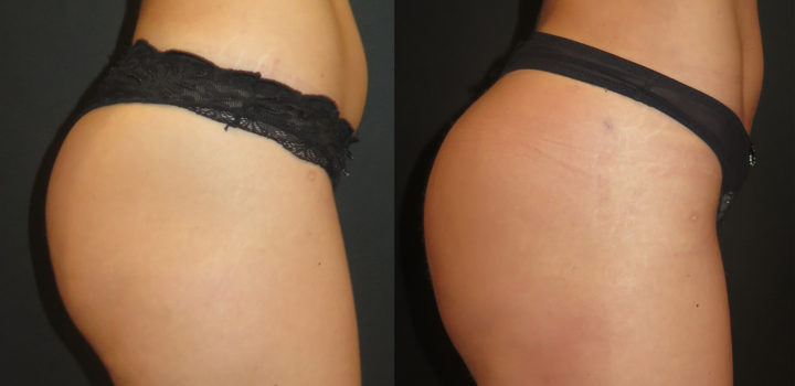 lipofilling de fesses