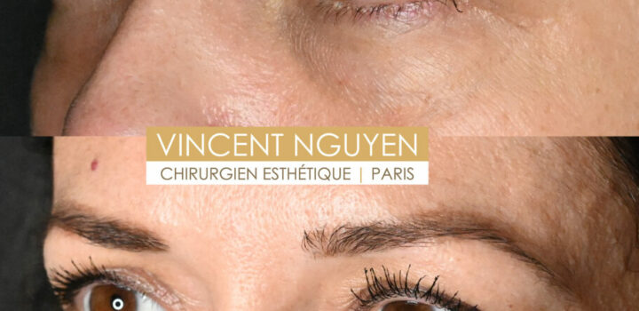 blepharoplasteinferieure3-910x1024