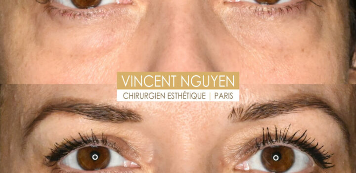 blepharoplastieinferieure1-1024x938