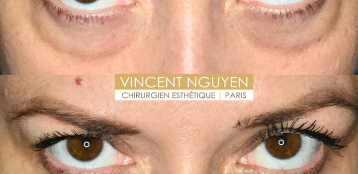 blepharoplastieinferieure3-999x1024