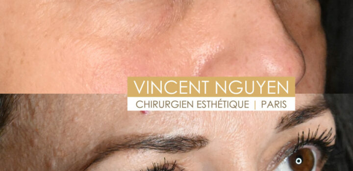 blepharoplastieinferieure5-851x1024