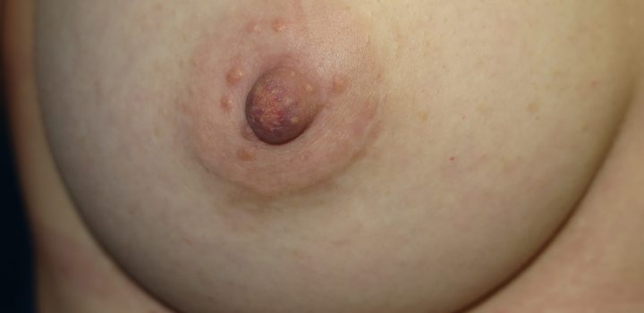 cicatrice péri-areolaire pour augmentation mammaire par prothèse