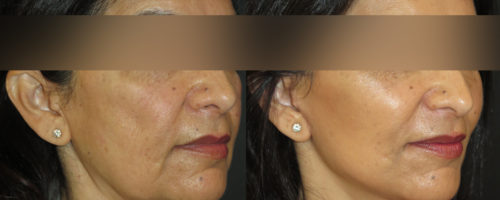 lifting cervico facial