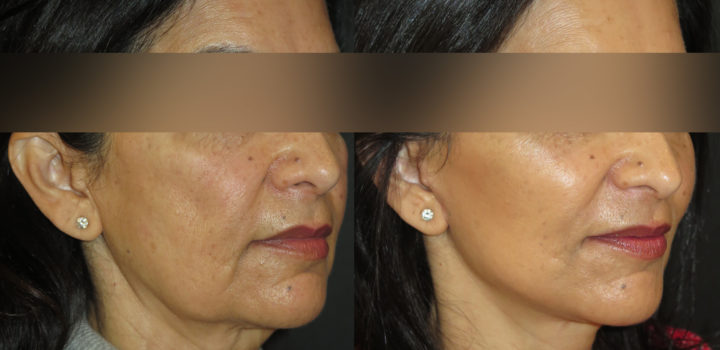 lifting cervico facial