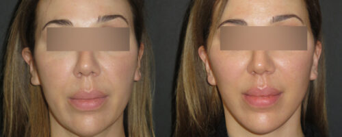 Lifting cervico facial