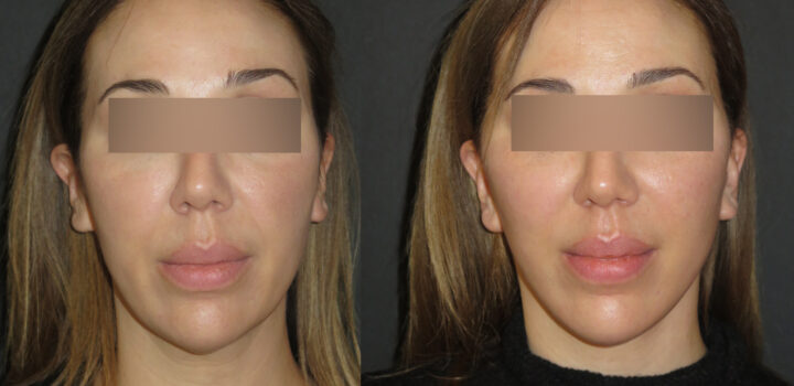 Lifting cervico facial