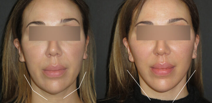 lifting cervico facial