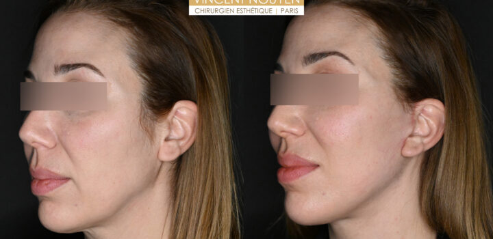 lifting cervico facial