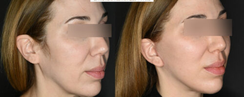 lifting cervico facial