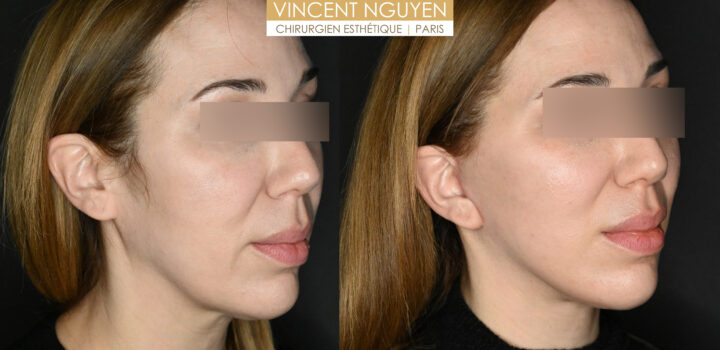 lifting cervico facial