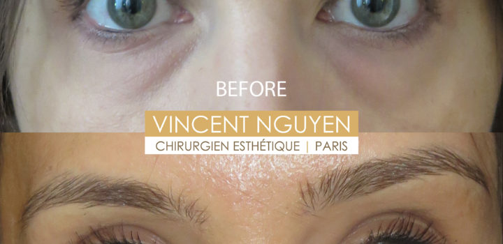 blépharoplastie inférieure