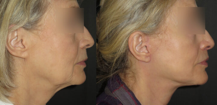 lifting cervico facial